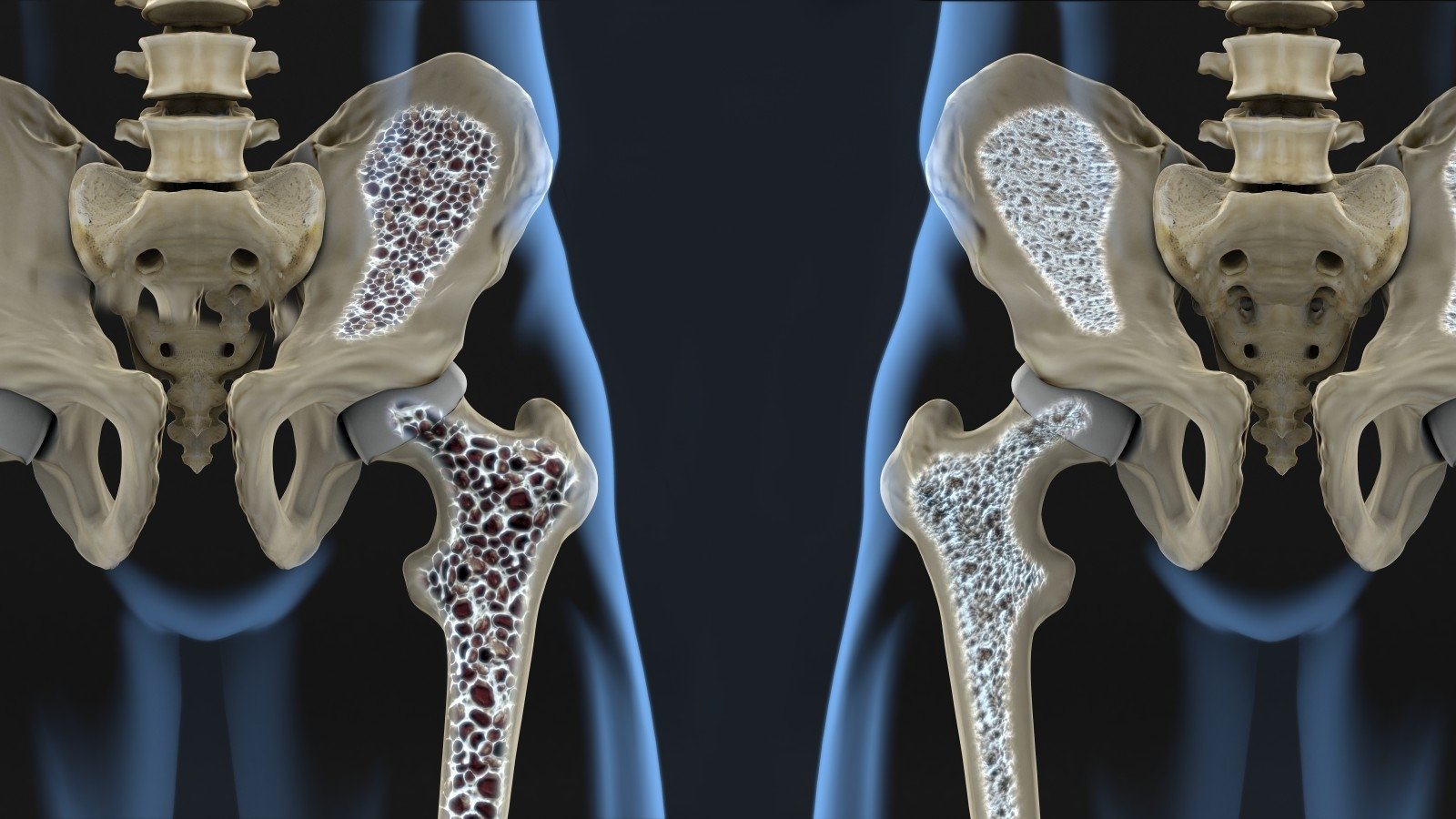 fizinis-aktyvumas-sergant-osteoporoze